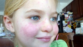 Kas oled külma suhtes allergiline? Paljud ei saa sellest ise arugi