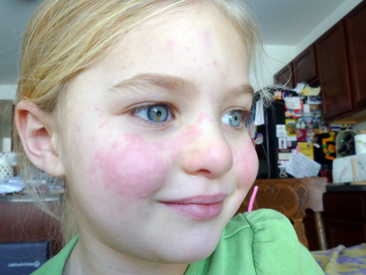 Kas oled külma suhtes allergiline? Paljud ei saa sellest ise arugi