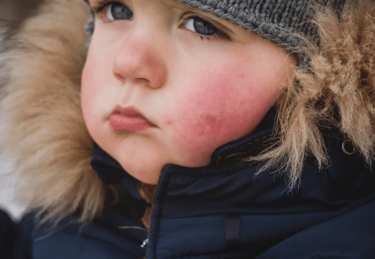 Kas oled külma suhtes allergiline? Paljud ei saa sellest ise arugi
